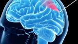 В России разработан стопроцентный метод биопсии опухоли мозга