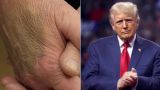 Daily Beast: Трамп скрывает гематомы под тональным кремом