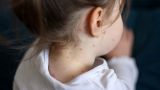 В Великобритании ребенок погиб после заражения корью